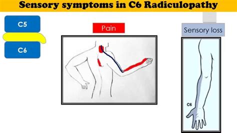 Cervical Radiculopathy C6