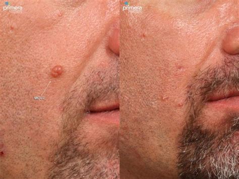 Cyst Removal Before And After Photo Gallery Orlando Florida