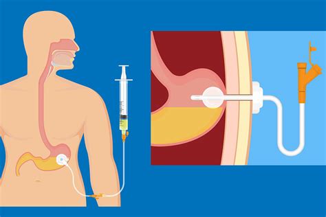 Gastrostomie dalimentation Gastro entérologue Lyon