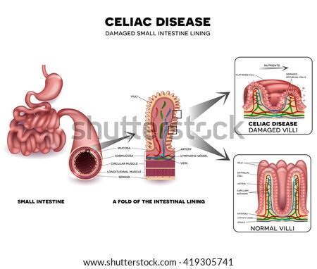 Celiac Disease Small Intestine Lining Damage Stock Illustration