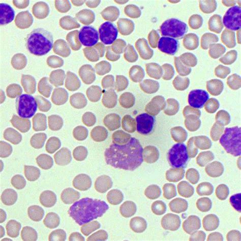 Lymphocytes | Blood Film - MedSchool