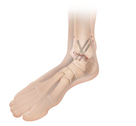 Arthrex Arthroscopic Ankle Fusion