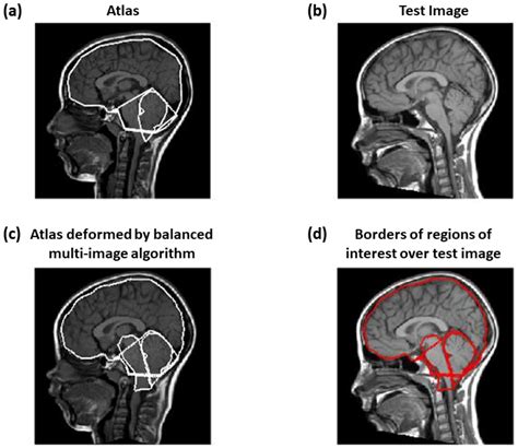 Chiari Malformation Types 1 4