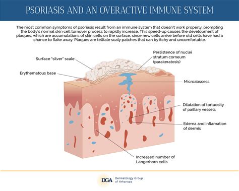 Psoriasis | Little Rock and Beyond | Dermatology Group of Arkansas