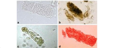 Urine Sediment Of The Month Waxy Casts Renal Fellow Network