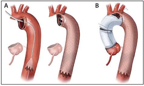 Hybrid Techniques For Surgical Repair Of Acute Type A Aortic Dissection