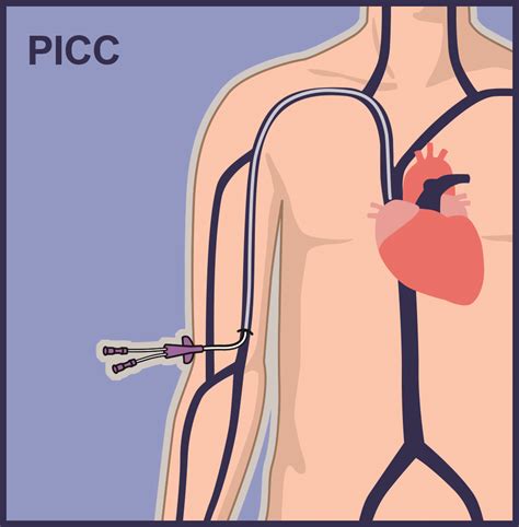 Arrow Picc Catheters