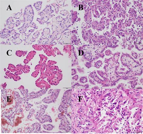 Papillary Renal Cell Carcinoma Grading And Types A Type B Type