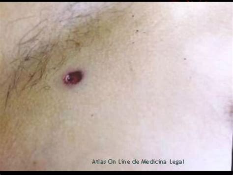 Heridas Por Arma De Fuego Ppt