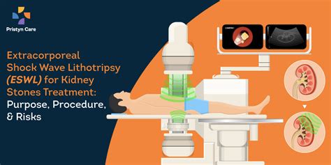 Extracorporeal Shock Wave Lithotripsy