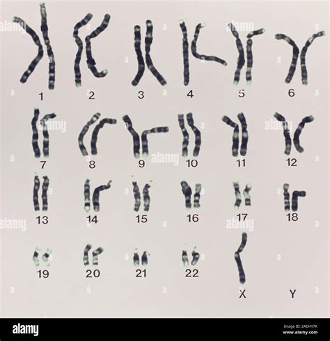 Syndrome De Turner La Lumière Microphotographie Des Chromosomes Le