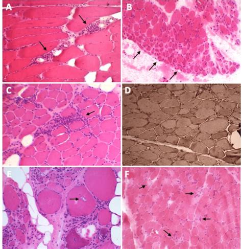 Dermatomyositis Histology