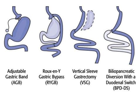 Minimal Access Bariatric And Metabolic Surgery