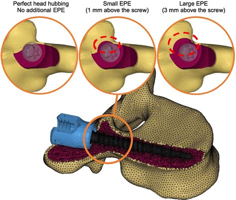 Thoracic Pedicle Screw Fixation Under Axial And Perpendicular Loadings