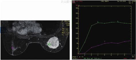 【附图】 乳腺磁共振检查技术 乳腺肿瘤学 天山医学院