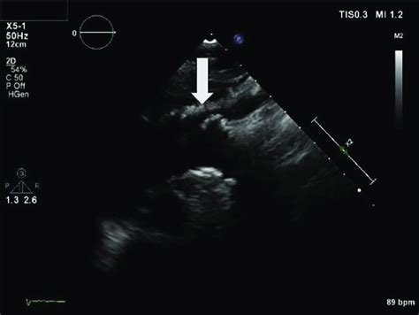 Two Dimensional Transthoracic Echocardiography Suprasternal View