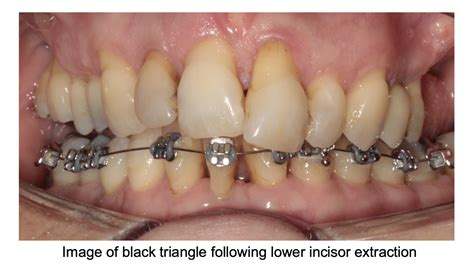 Lower Incisor Extraction In Orthodontics Dastardly Or Excellence