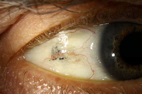 Conjunctival Foreign Body