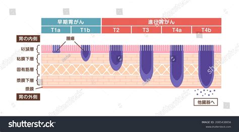 Stages Stomach Cancer Gastric Cancer Vector Stock Vector (Royalty Free ...