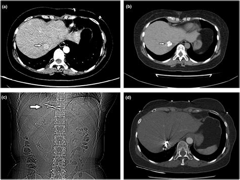 A 49 Year Old Female Patient With One Hepatocellular Carcinoma Nodule