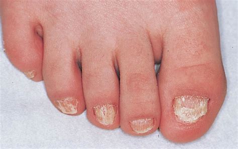 Nail Lichen Planus In Children Clinical Features Response To