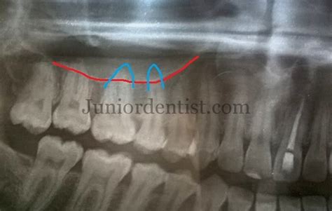 Can Tooth Infection Cause Sinus Infection