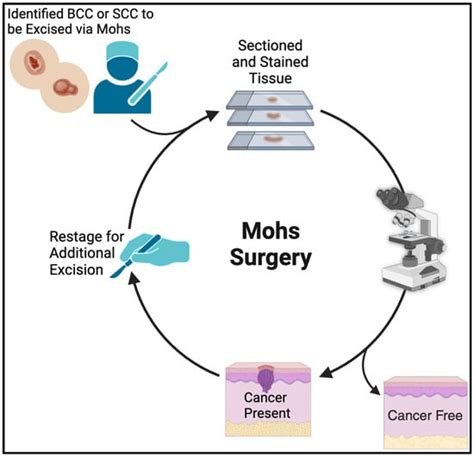 Cancers Free Full Text Factors Influencing Margin Clearance And The Number Of Stages Of Mohs