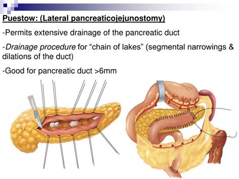PPT - PANCREAS PowerPoint Presentation, free download - ID:5299444