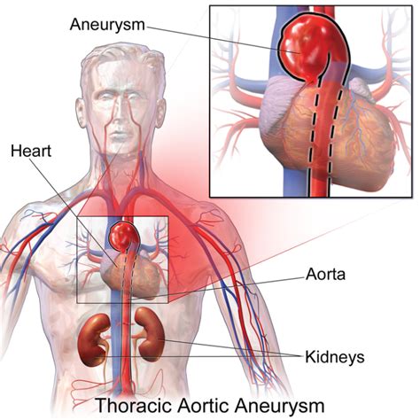 Difference Between True and False Aneurysm | Compare the Difference ...