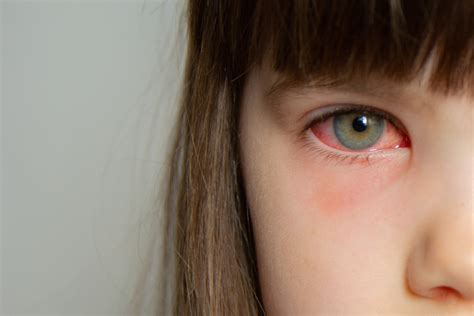 Pink Eye Conjunctivitis Infection Its Symptoms Treatment And