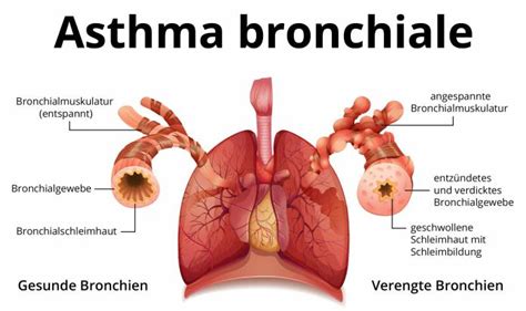 Asthma Bronchiale