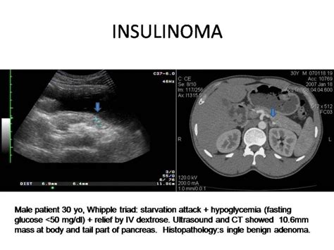 Insulinom - DocCheck