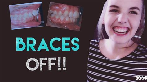 Getting My Braces Off Experience Vlog Youtube