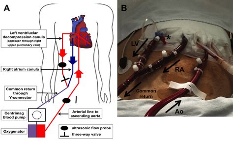 Illustration Of Central Ecls Setup With Lv Vent Left Ventricular A