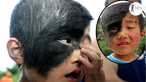 Top 10 Rarest Birthmarks You Have Ever Seen Alltimetop Via