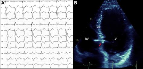 Late Onset Interventricular Septal Perforation From Left Bundle Branch