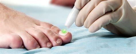 Fungal Nail Laser Treatment Sydney- The Podiatry Centre