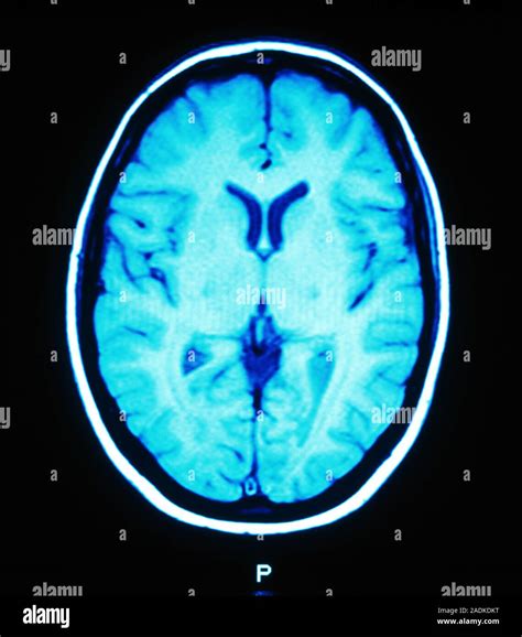 Healthy Brain Coloured Magnetic Resonance Imaging MRI Scan Of An