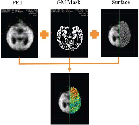 Figure From Mr Less Surface Based Amyloid Assessment Based On C Pib