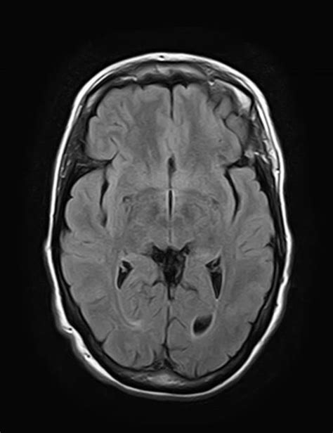 Skull Vault Osteoma Mri Image Radiopaedia Org