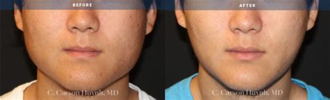 Everything About V Line Jaw Surgery Radiance Surgery And Aesthetic Medicine