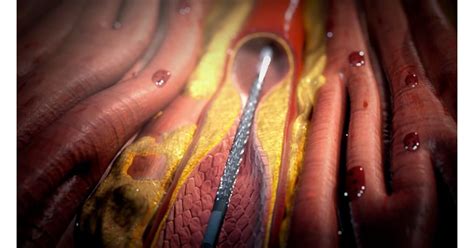 Stent Procedure High Impact® Visual Litigation Strategies™