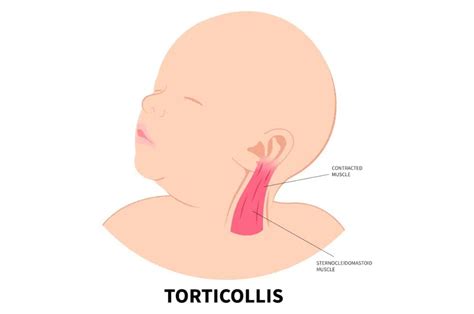 Spotting And Preventing Torticollis Tips For Parents Uplift Therapy