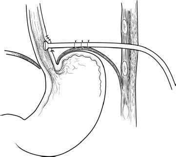 Modified T Tube Repair Of Delayed Esophageal Perforation Results In A