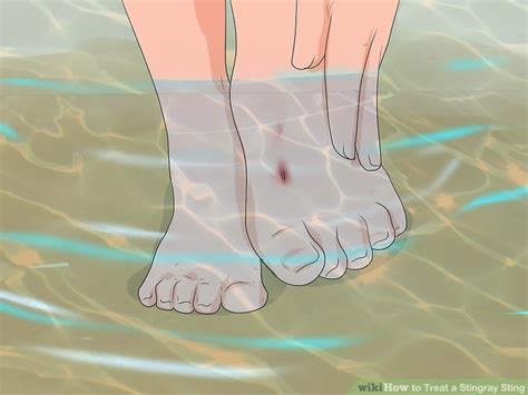 How to Treat a Stingray Sting: 11 Steps (with Pictures) - wikiHow