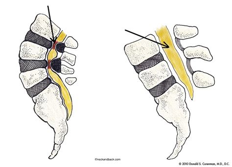 Lumbar Spinal Stenosis And Neurogenic Claudication Welcome Back Clinic Mri And Pain