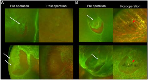 Lattice degeneration (LD) associated with rhegmatogenous retinal ...