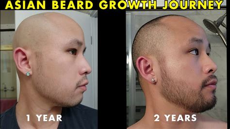 Minoxidil Beard Asian