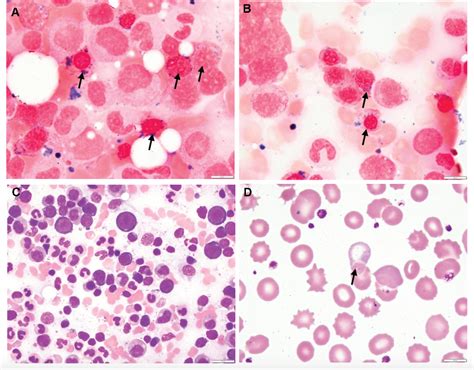 Sideroblastic Anemia Pathophysiology