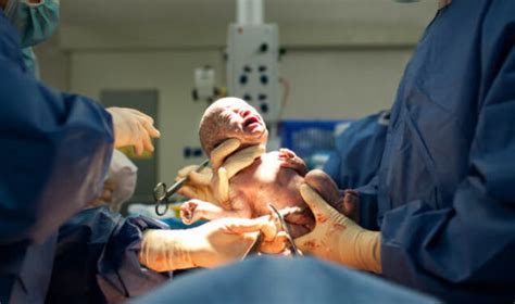 Birth Injuries From Forceps Delivery Complications